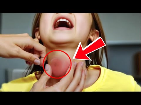 Mom Ignored Her Daughter’s Weird Neck Pimple… Until It Got Bigger—And the Truth Left Her in Shock!